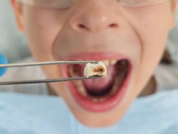 Best Emergency Tooth Extraction in Lisbon, IA