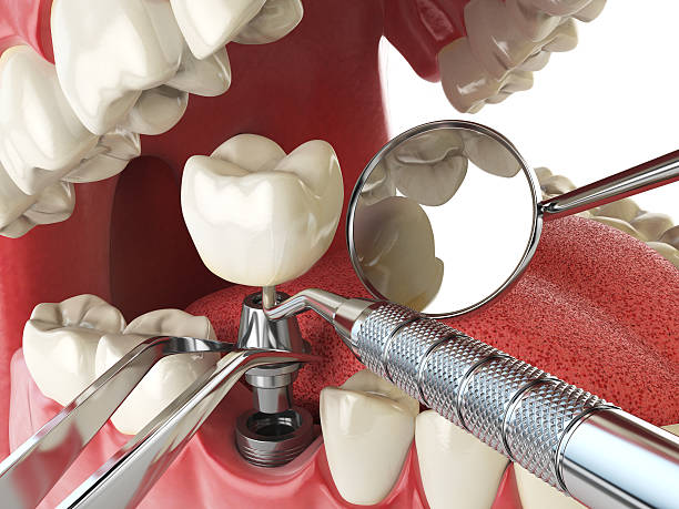 Best Emergency Treatment for Dental Infections or Abscesses in Lisbon, IA